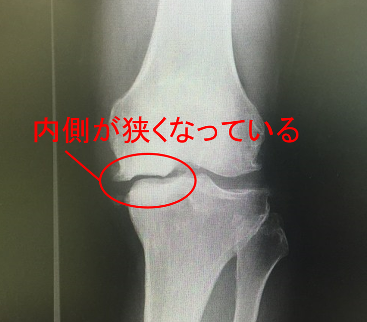 変形性膝関節症　レントゲン画像１